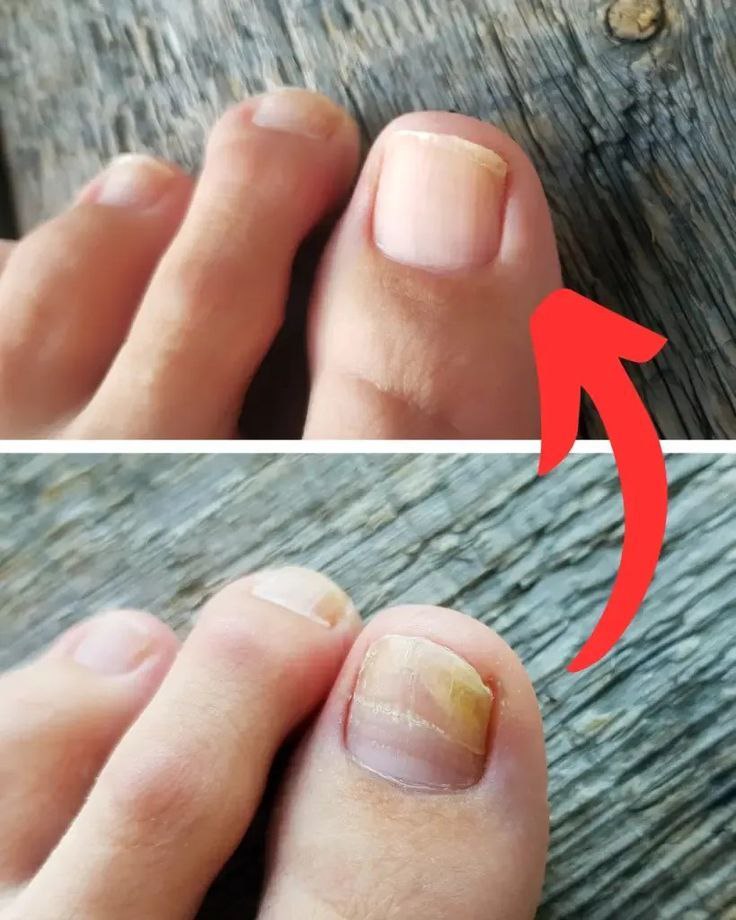 GingerGlow™ – Votre Solution Naturelle pour des Ongles Sains