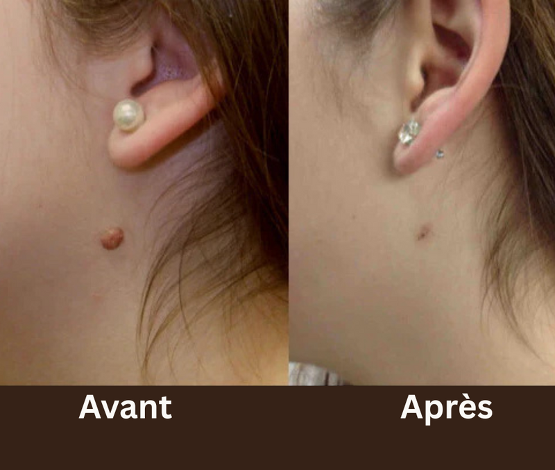 Dites Adieu aux Acrochordons : La Solution Simple et Efficace pour Une Peau Lisse