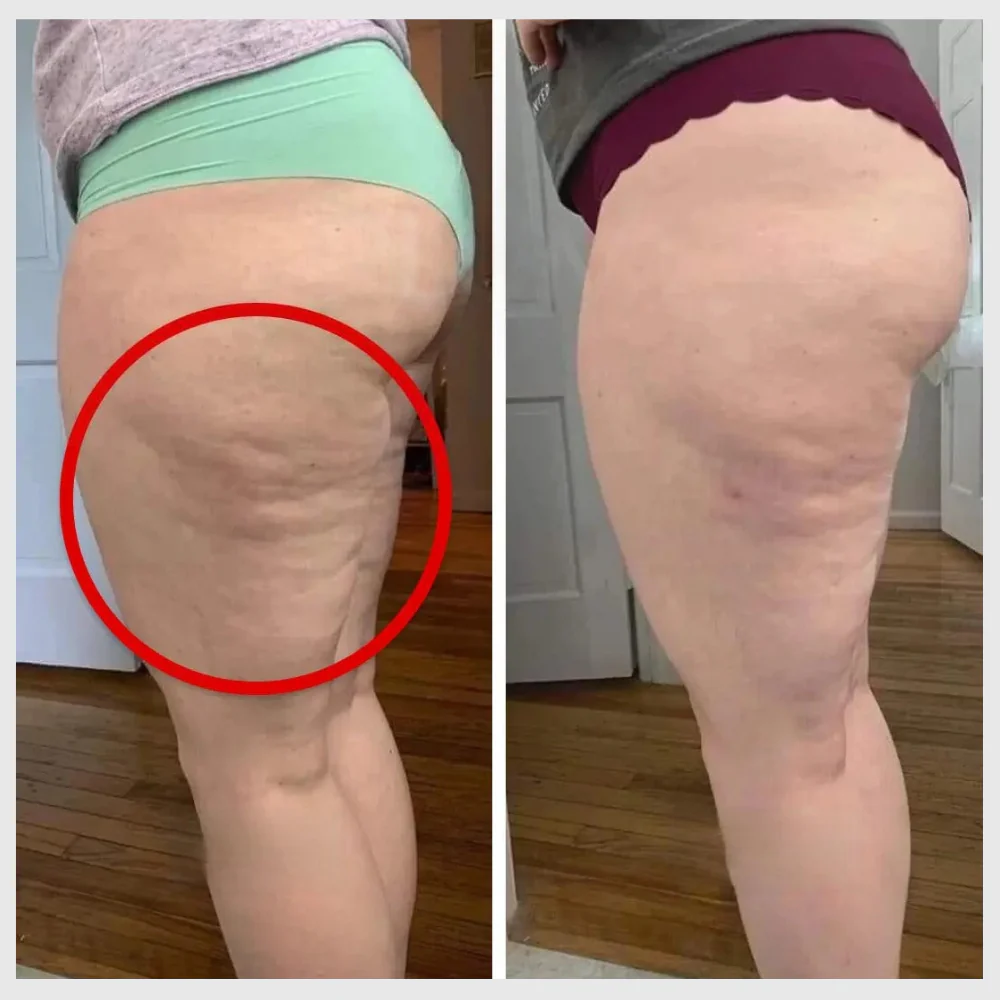CircuFit - La Solution Naturelle Contre la Cellulite