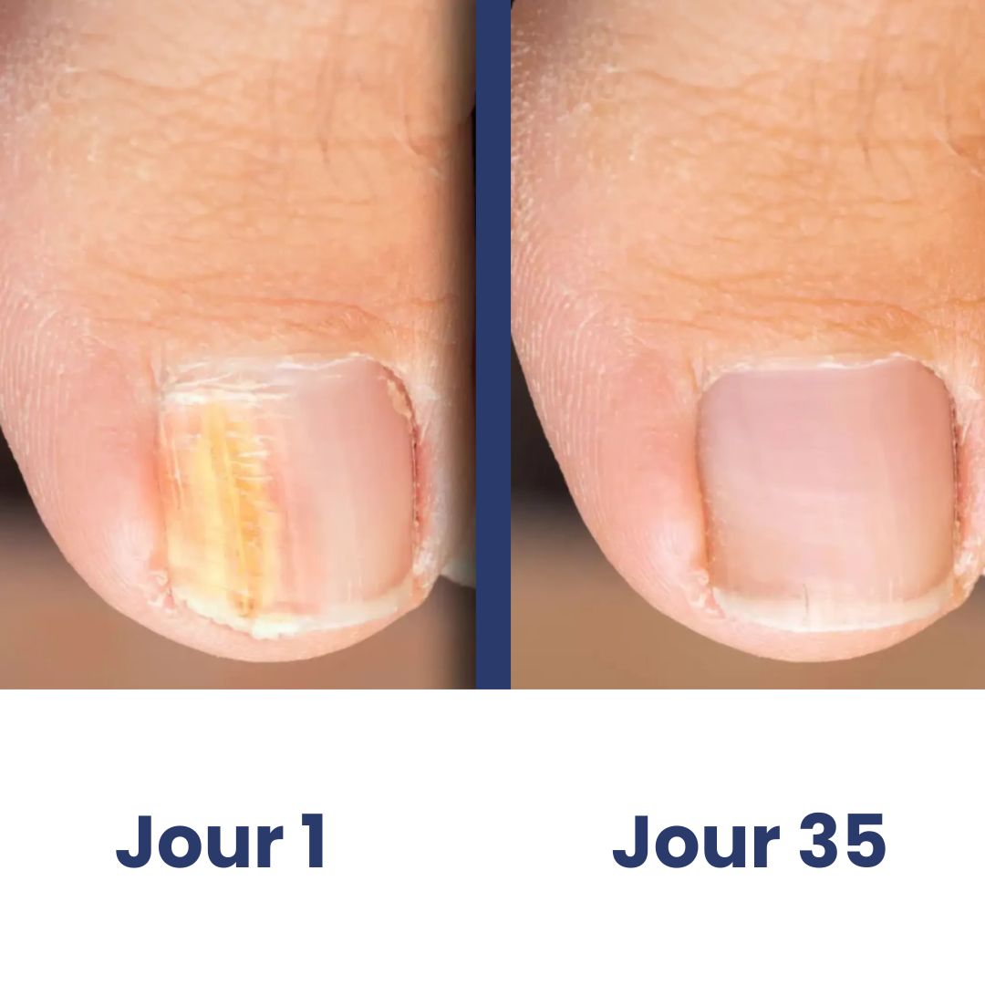ClairOngle  – Soin Doux par Lumière Ciblée