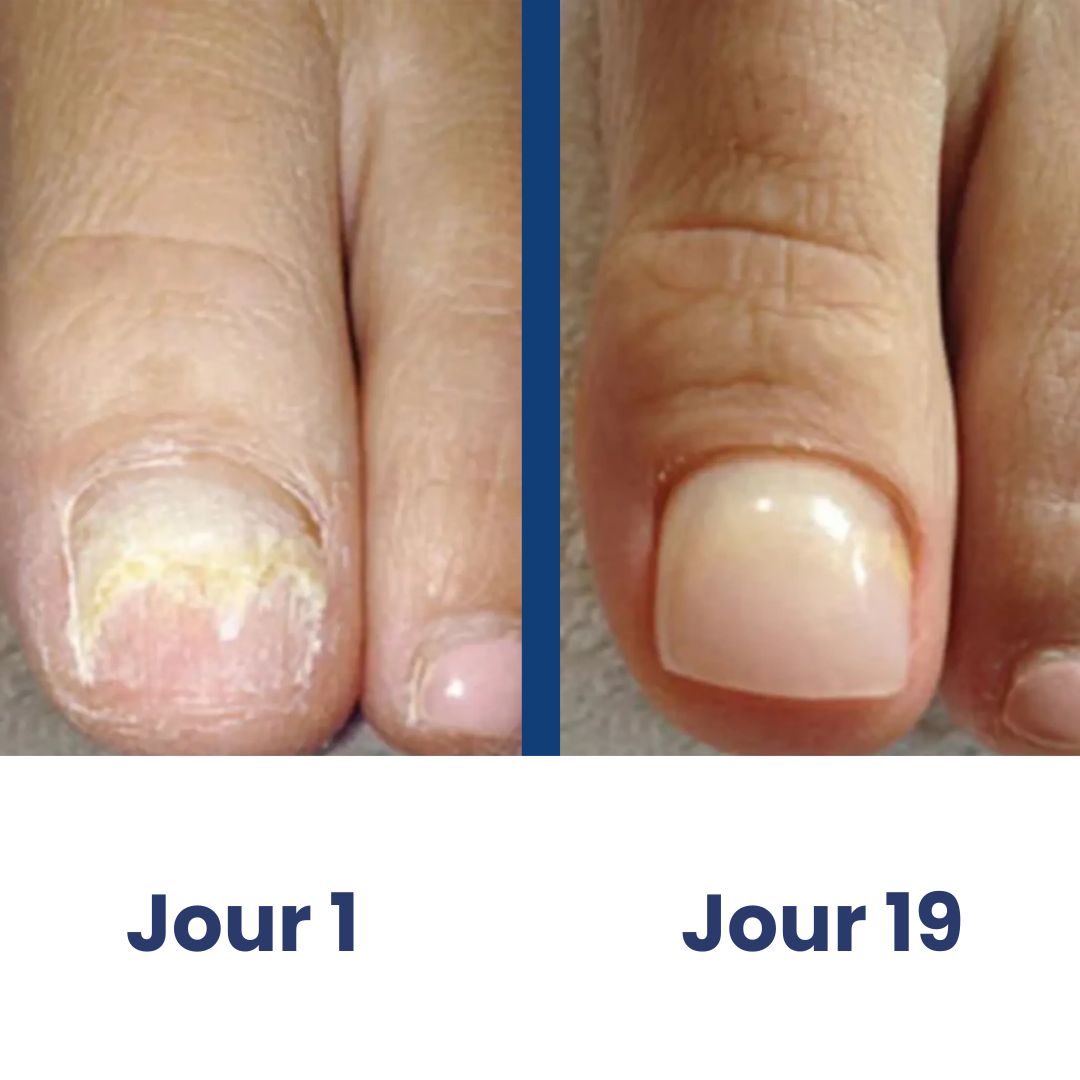 ClairOngle  – Soin Doux par Lumière Ciblée