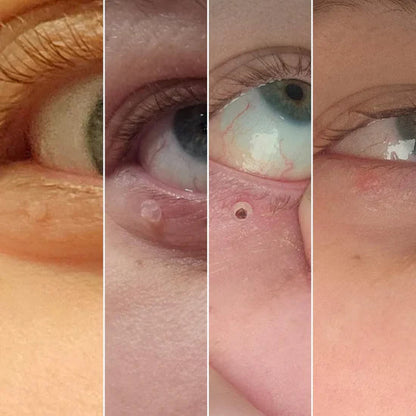 Dites Adieu aux Acrochordons : La Solution Simple et Efficace pour Une Peau Lisse