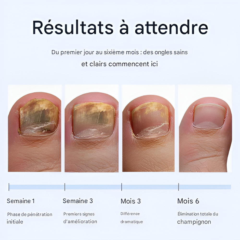 PiedClair™ – Stylo Antifongique pour Ongles Sains