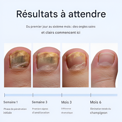 PiedClair™ – Stylo Antifongique pour Ongles Sains